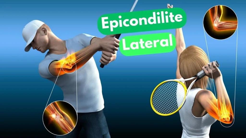 Ilustração mostrando dois atletas, um homem e uma mulher, realizando movimentos de raquete com destaque em luz laranja nas articulações do cotovelo, representando dor causada por epicondilite lateral, também conhecida como cotovelo de tenista.